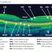 OCT Retinal Scan