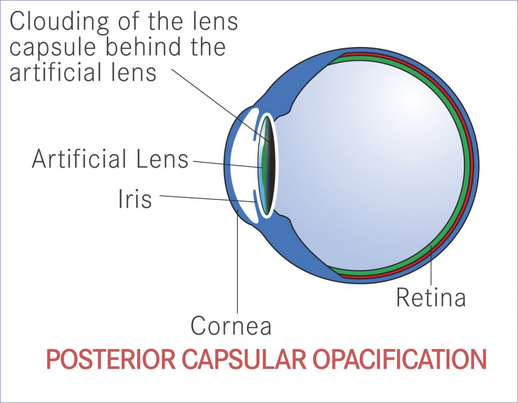 Yag Capsulotomy for Posterior Capsular Opacification Noel Templeton
