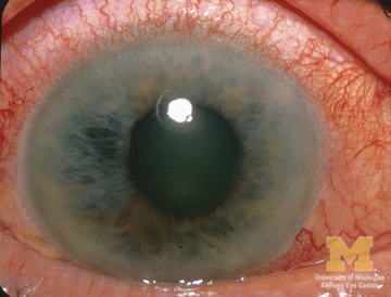 Acute Glaucoma