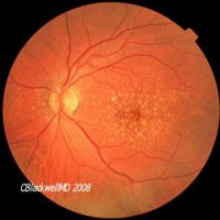 The Ageing Retina - An Introduction to Macular Degeneration