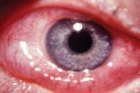 Allergic Conjunctivitis