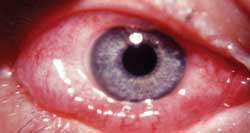 Allergic Conjunctivitis Often Seasional