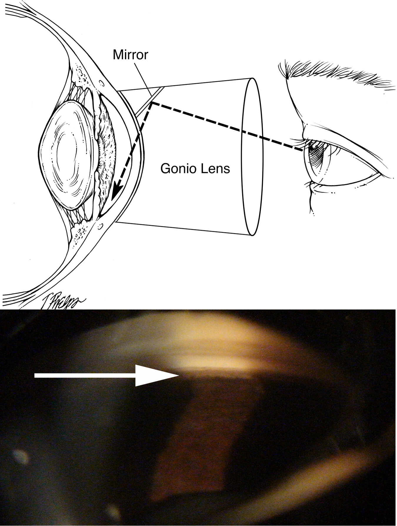 Angle Closure Glaucoma or Acute Glaucoma