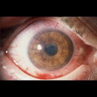 Anterior Uveitis or Iritis