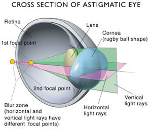 Astigmatism Just Eye Shape Problem