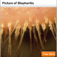 Blepharitis