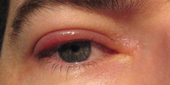 Blepharitis Discomfort Irritation