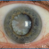 Cataract Surgery