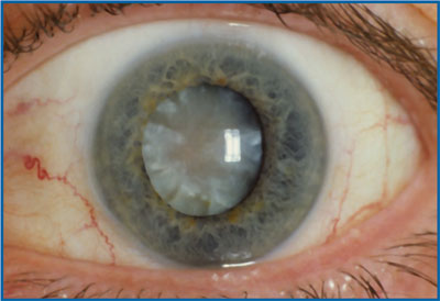 Cataract Eye