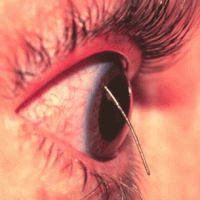 Remove Metal foreign body from the Cornea