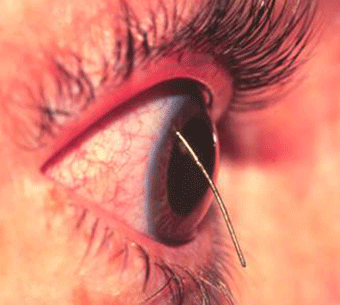 Common Eye Injuries