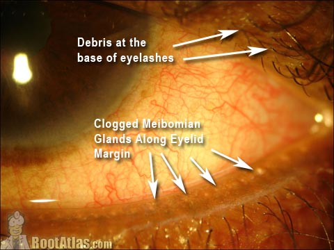 Condition Blepharitis