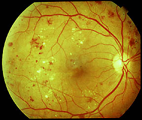 Diabetic Retinopathy