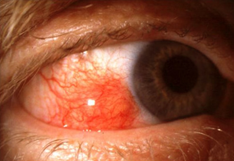 Red Eye Due to Episcleritis