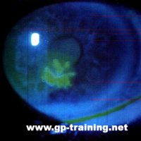 Herpes in the Eye - Herpes Simplex Keratitis