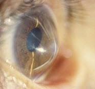 What is keratoconus?