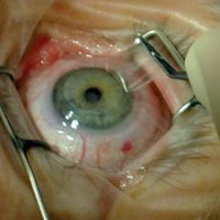 High Definition Lasik Eye Surgery