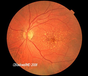 Macular Degeneration