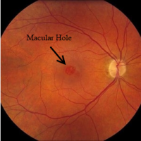 Macula Hole