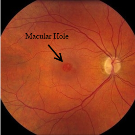 Macular Hole Image