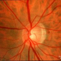 Optic Neuritis - Pain on Eye movement, reduced vision