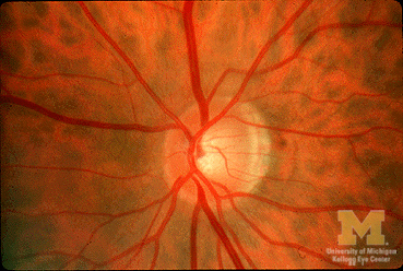 Normal Optic Disc