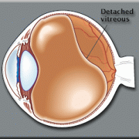 Posterior Vitreous Detachment - The Cause of Floaters and Flashes