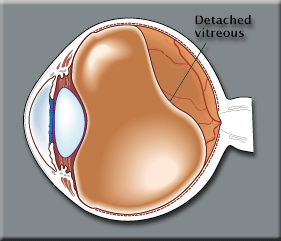 Posterior Vitreous Detachment Cause Floaters Flashes