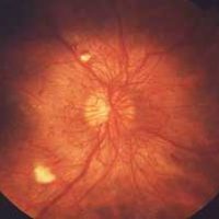 Proliferative Diabetic Retinopathy - PDR