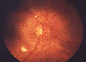 Proliferative Diabetic Retinopathy Pdr