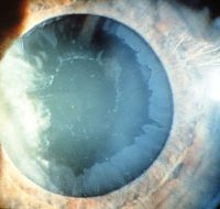 Pseudoexfoliation Syndrome and Glaucoma