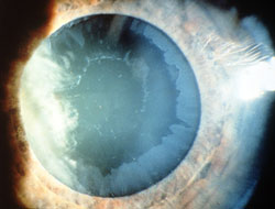 Pseudoexfoliation Syndrome Glaucoma