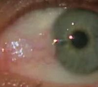 Pterygium - Growth on white of the Eye