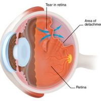 What is a Retinal-Detachment ?