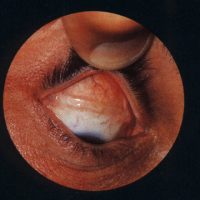 Retinal Detachment Surgery - Scleral Buckle and Vitrectomy