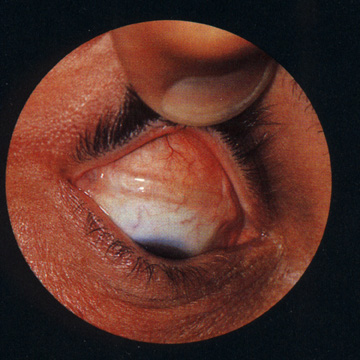 Retinal Detachment Surgery Scleral Buckle Vitrectomy Scleral Buckle
