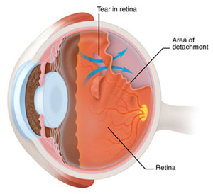 Retinal Detachment Surgery Scleral Buckle Vitrectomy