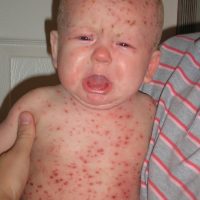Herpes Zoster commonly known as Shingles