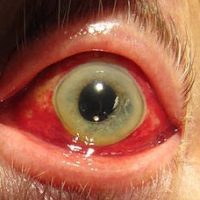 Subconjunctival hemorrhage - burst blood vessel in my eye
