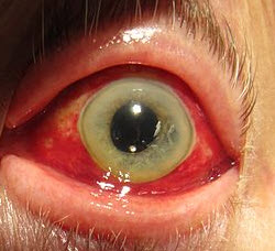 Subconjunctival Hemorrhage Burst Blood Vessel Eye