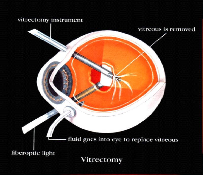 Vitrectomy