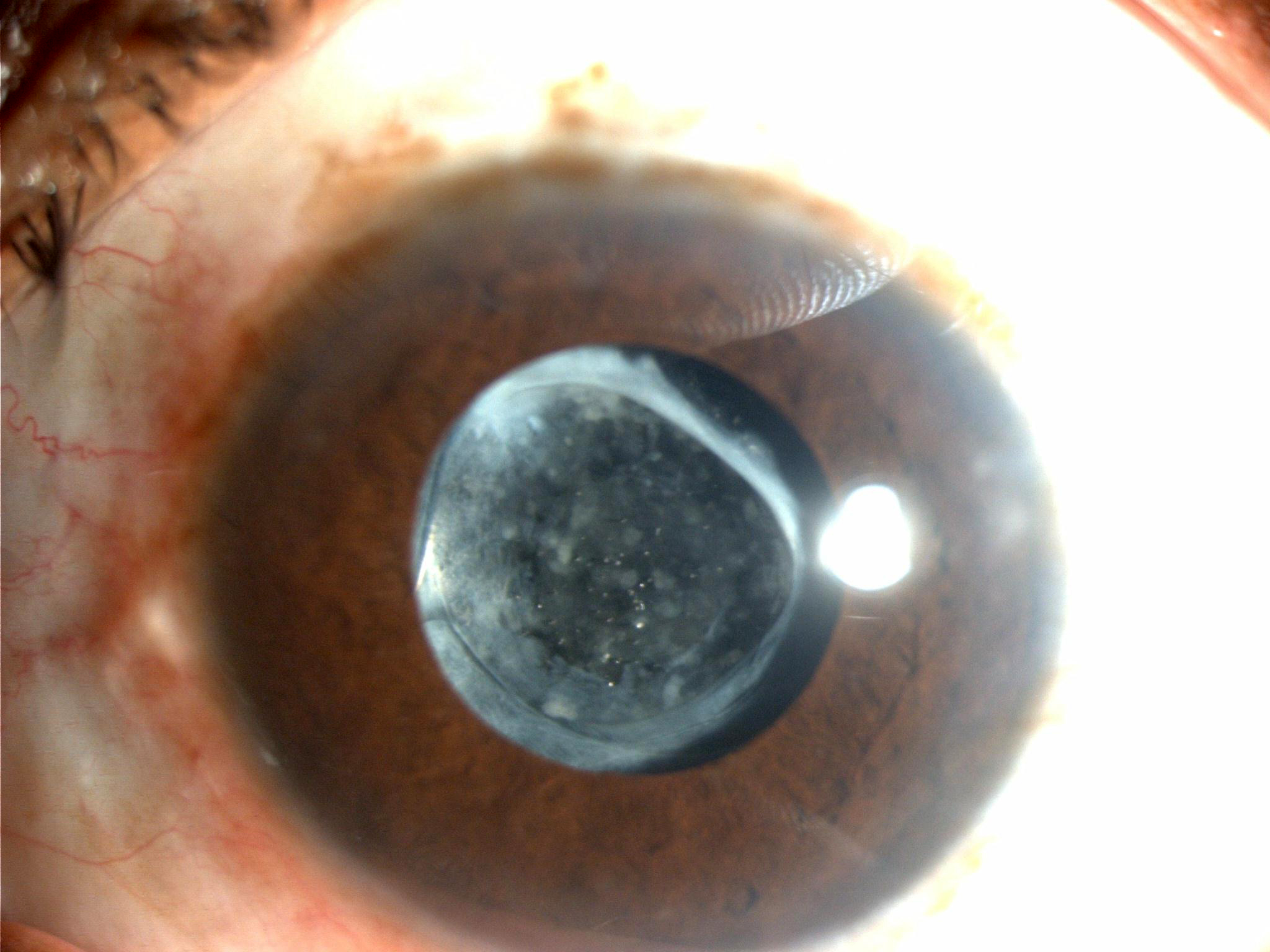 Yag Capsulotomy Posterior Capsular Opacification